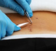 Cómo cuidar tu piel después de una cirugía; pasos clave para una recuperación sin marcas