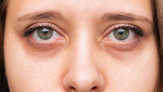 Por qué salen las ojeras y cómo evitarlas: causas reales y soluciones efectivas