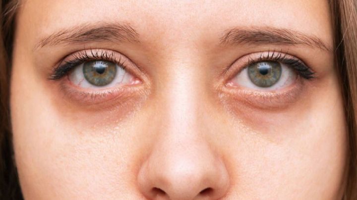 Por qué salen las ojeras y cómo evitarlas: causas reales y soluciones efectivas