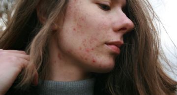 Cuatro tratamientos para eliminar las cicatrices de acné; opciones efectivas para recuperar tu piel