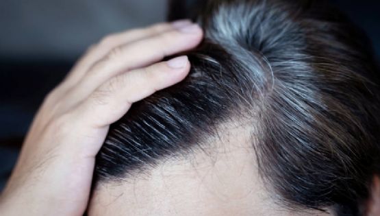 ¿Tu cabello se volvió blanco de pronto? El estrés podría ser la causa