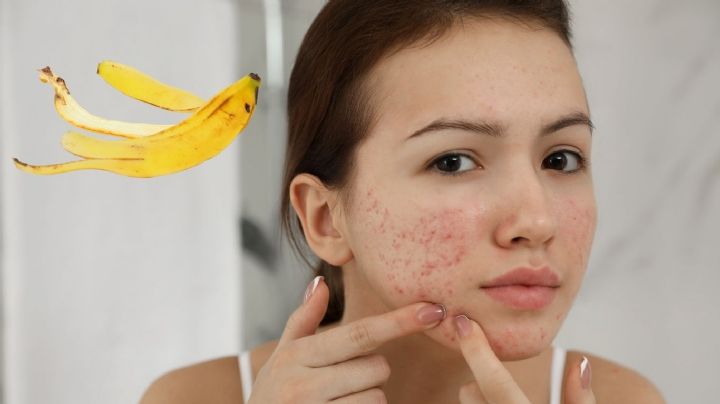 ¿Manchas y acné? Así puedes usar la cáscara de plátano para mejorar tu piel