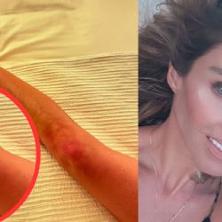 MOMENTO EXACTO en que Anahí muestra los moretones que le causó la 'pelea' con Karol G