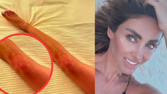 MOMENTO EXACTO en que Anahí muestra los moretones que le causó la 'pelea' con Karol G