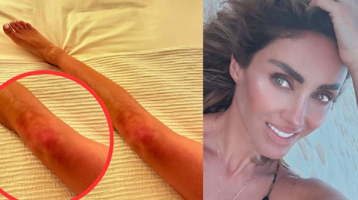 MOMENTO EXACTO en que Anahí muestra los moretones que le causó la 'pelea' con Karol G